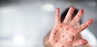 26 de decese din cauza rujeolii în marie, dintre care unul în județul Vaslui