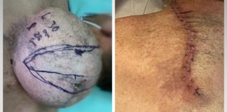 Record medical: Tumoră de două kilograme, extirpată la Spitalul Județean Vaslui